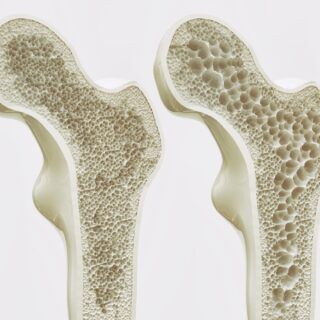 Osteoporose – Ursachen, Symptome und Behandlung